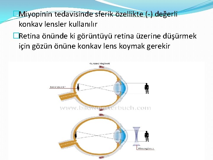 �Miyopinin tedavisinde sferik özellikte (-) değerli konkav lensler kullanılır �Retina önünde ki görüntüyü retina