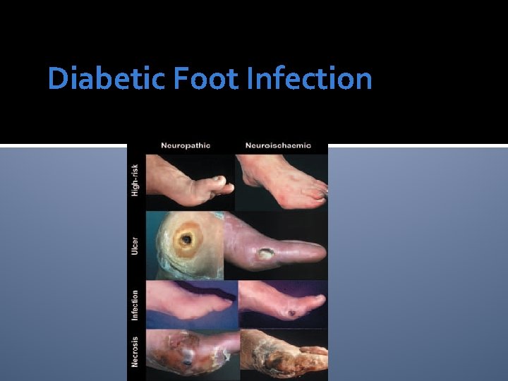 Diabetic Foot Infection 