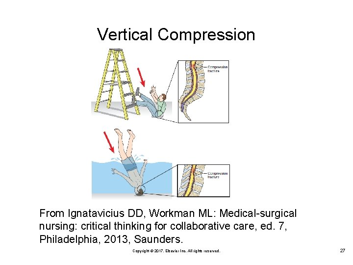 Vertical Compression From Ignatavicius DD, Workman ML: Medical-surgical nursing: critical thinking for collaborative care,