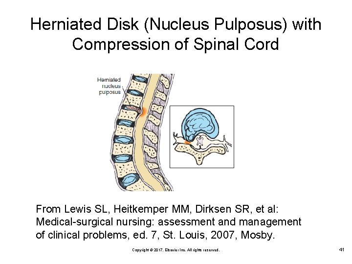 Herniated Disk (Nucleus Pulposus) with Compression of Spinal Cord From Lewis SL, Heitkemper MM,