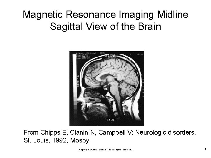 Magnetic Resonance Imaging Midline Sagittal View of the Brain From Chipps E, Clanin N,