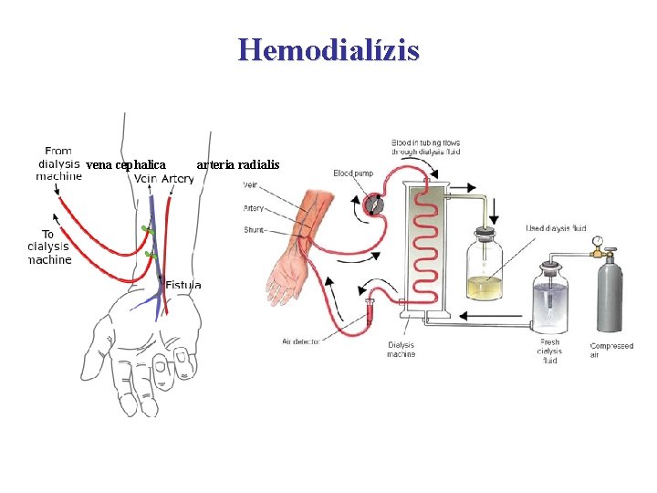 Hemodialízis vena cephalica arteria radialis 