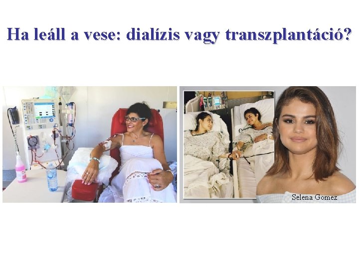 Ha leáll a vese: dialízis vagy transzplantáció? Selena Gomez 