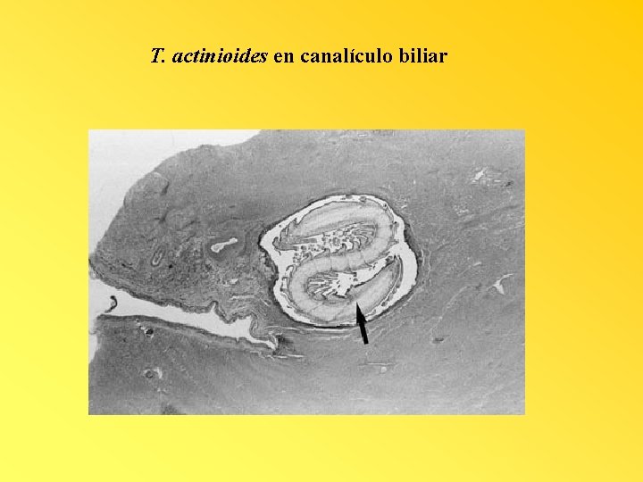 T. actinioides en canalículo biliar 