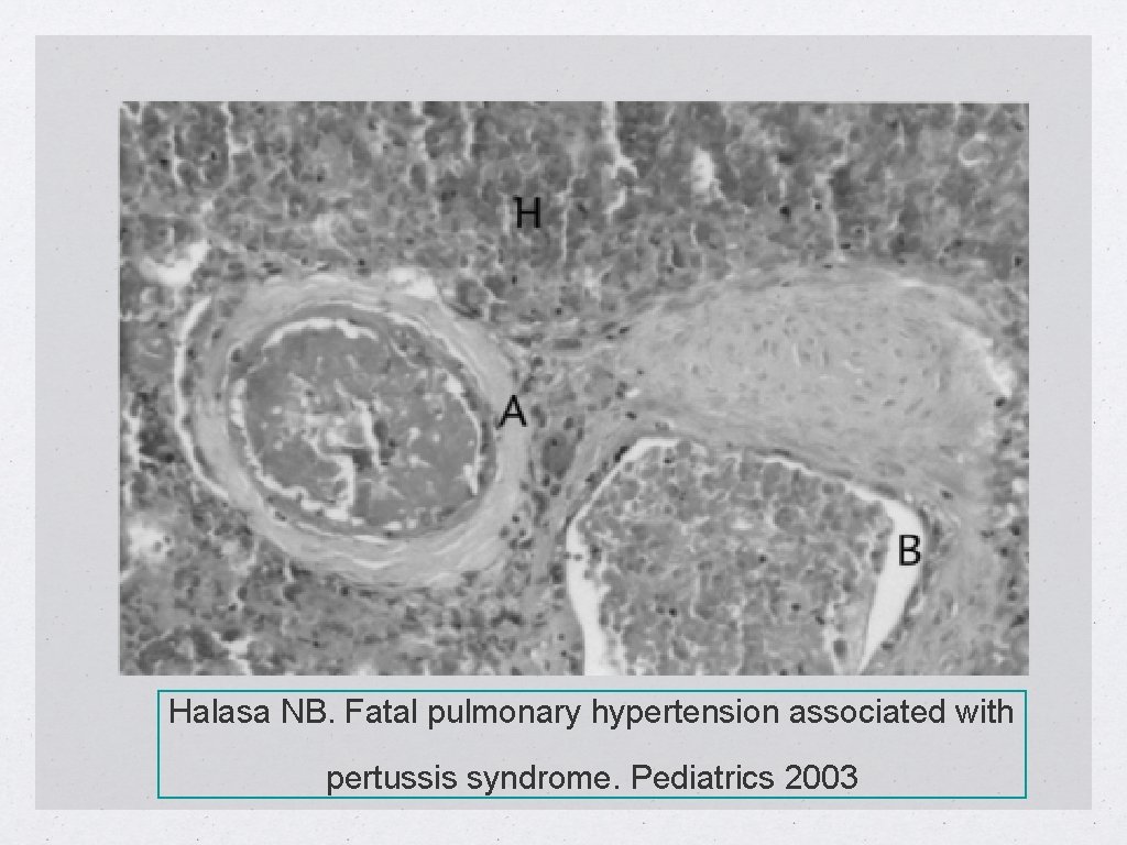 Halasa NB. Fatal pulmonary hypertension associated with pertussis syndrome. Pediatrics 2003 