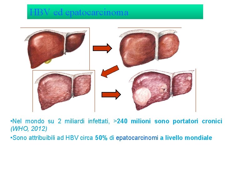 HBV ed epatocarcinoma • Nel mondo su 2 miliardi infettati, >240 milioni sono portatori