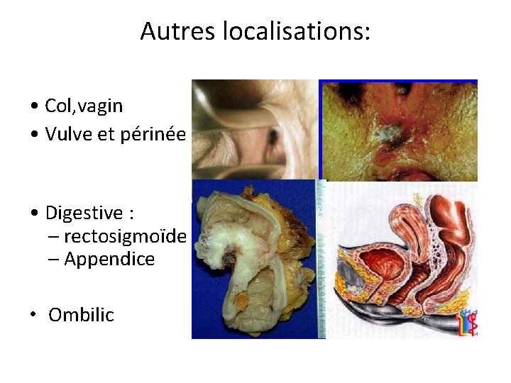 Autres localisations: • Col, vagin • Vulve et périnée • Digestive : – rectosigmoïde