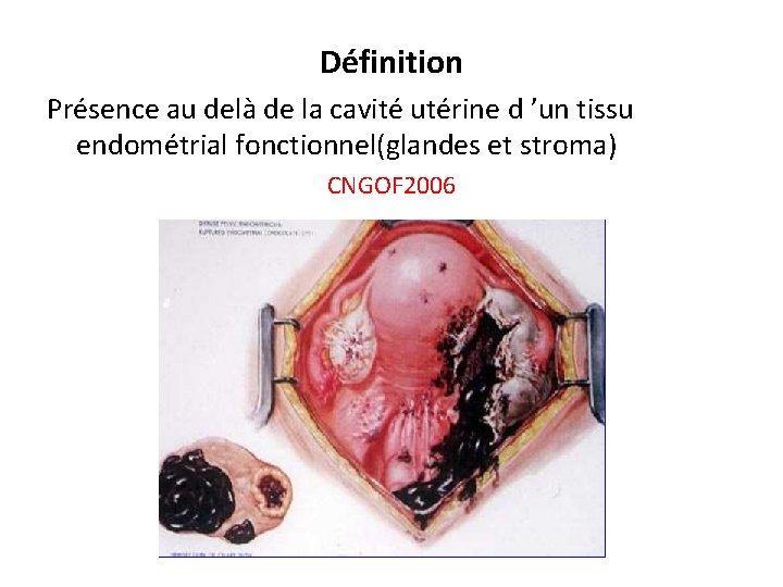 Définition Présence au delà de la cavité utérine d ’un tissu endométrial fonctionnel(glandes et