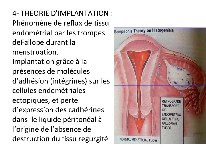 4 - THEORIE D’IMPLANTATION : Phénomène de reflux de tissu endométrial par les trompes