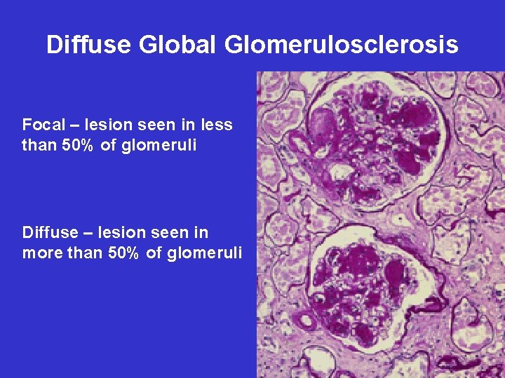 Diffuse Global Glomerulosclerosis Focal – lesion seen in less than 50% of glomeruli Diffuse