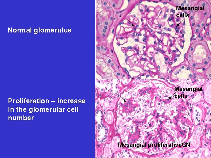 Mesangial cells Normal glomerulus Proliferation – increase in the glomerular cell number Mesangial cells