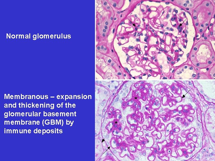 Normal glomerulus Membranous – expansion and thickening of the glomerular basement membrane (GBM) by