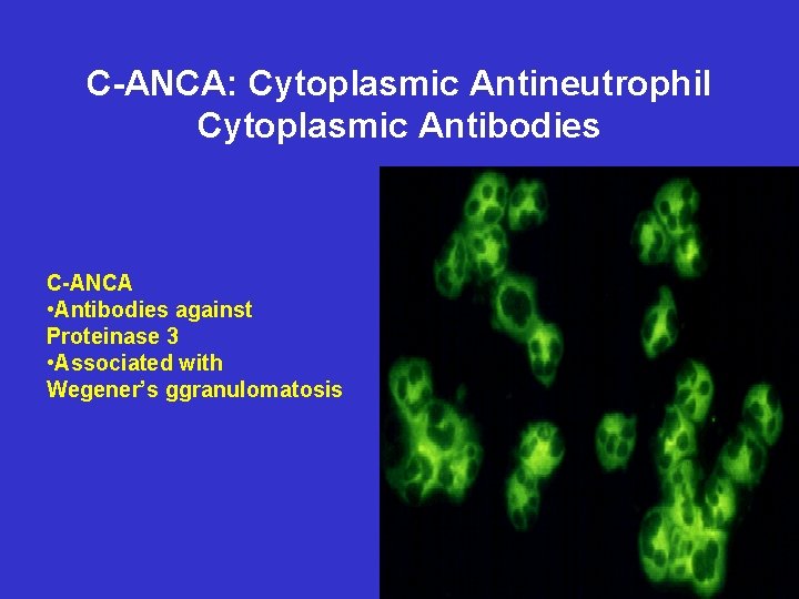 C-ANCA: Cytoplasmic Antineutrophil Cytoplasmic Antibodies C-ANCA • Antibodies against Proteinase 3 • Associated with