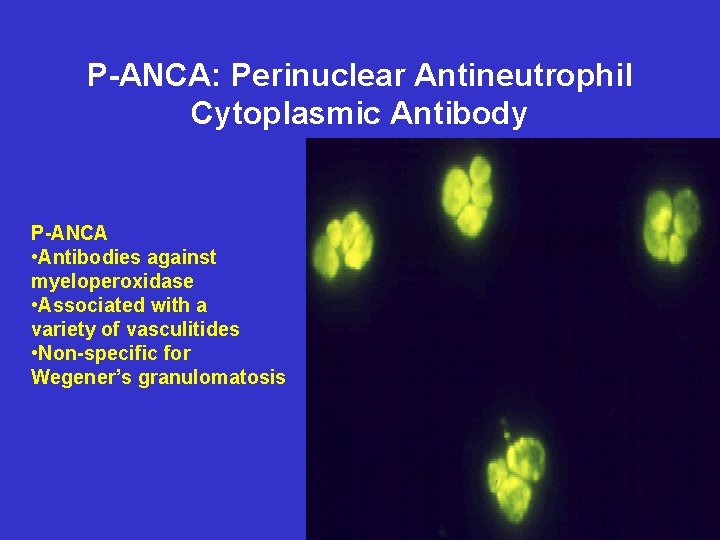 P-ANCA: Perinuclear Antineutrophil Cytoplasmic Antibody P-ANCA • Antibodies against myeloperoxidase • Associated with a