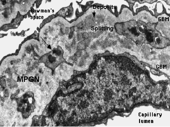 Deposits Splitting MPGN 