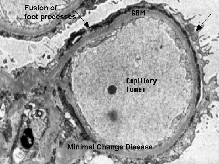 Fusion of foot processes Minimal Change Disease 