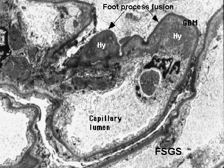 Foot process fusion FSGS 