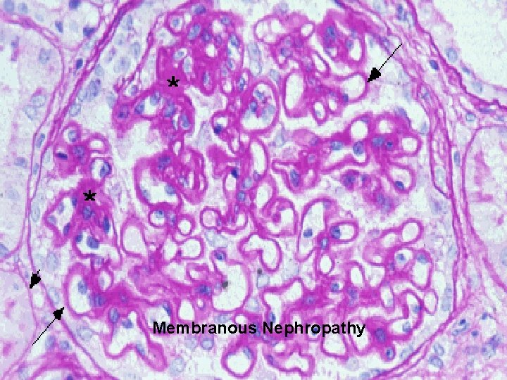 Membranous Nephropathy 