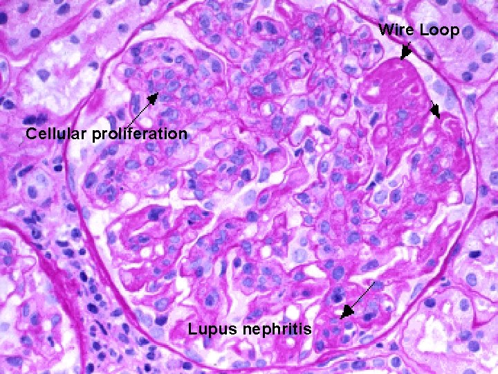 Wire Loop Cellular proliferation Lupus nephritis 