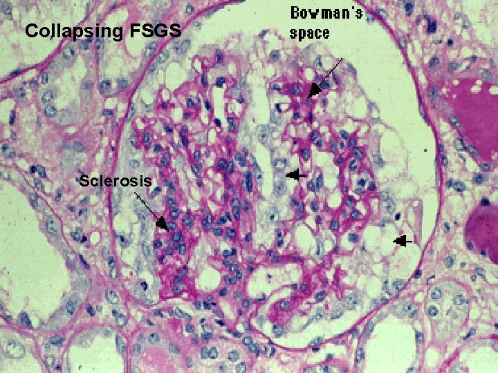 Collapsing FSGS Sclerosis 
