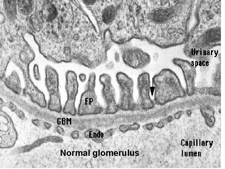 Normal glomerulus 