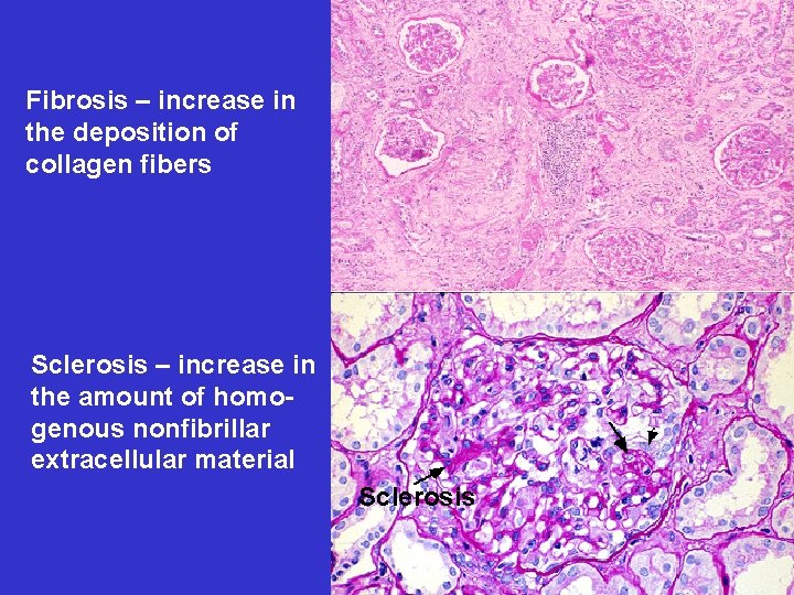 Fibrosis – increase in the deposition of collagen fibers Sclerosis – increase in the