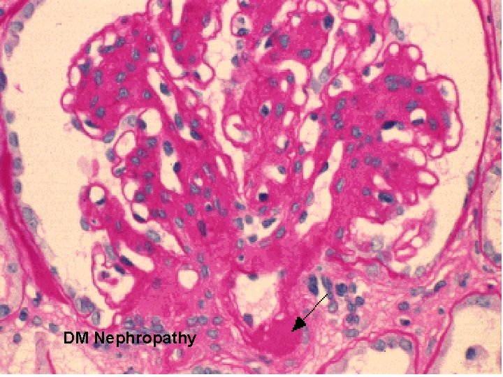 DM Nephropathy 