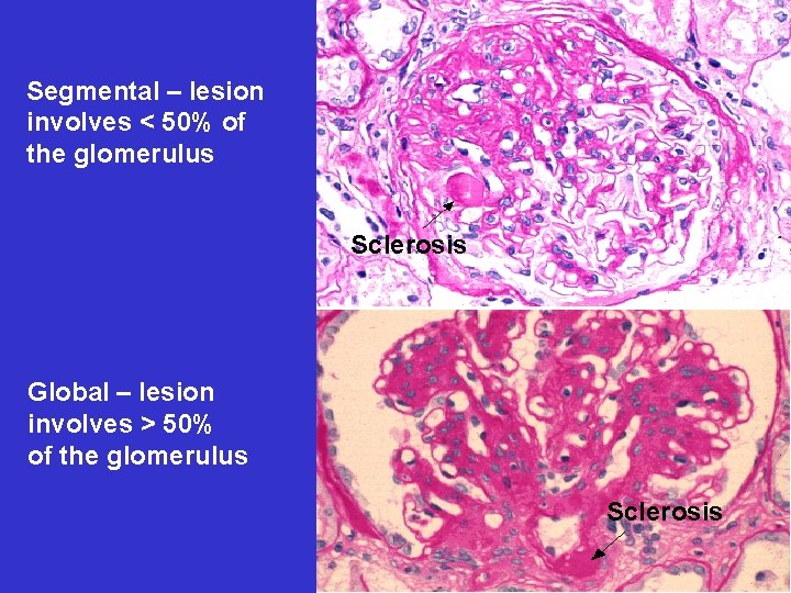 Segmental – lesion involves < 50% of the glomerulus Sclerosis Global – lesion involves