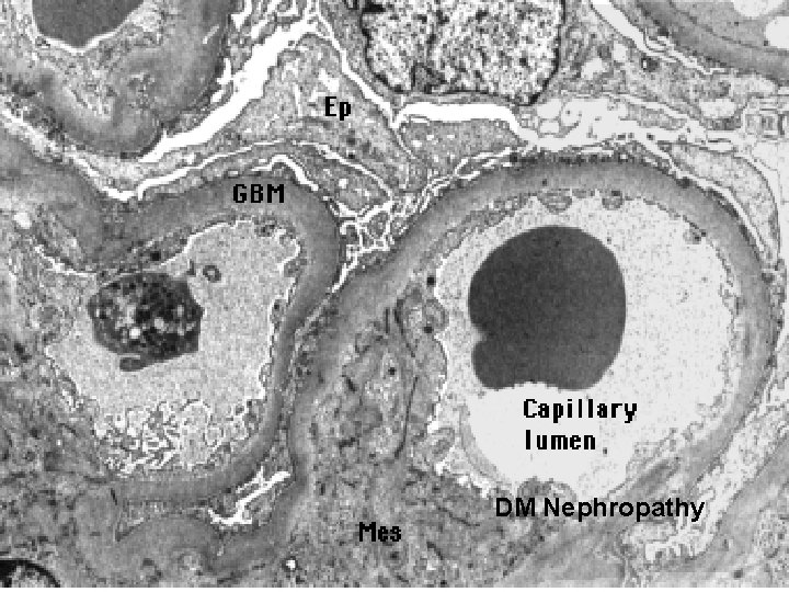 DM Nephropathy 