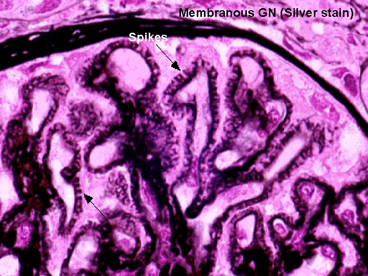 Membranous GN (Silver stain) Spikes 