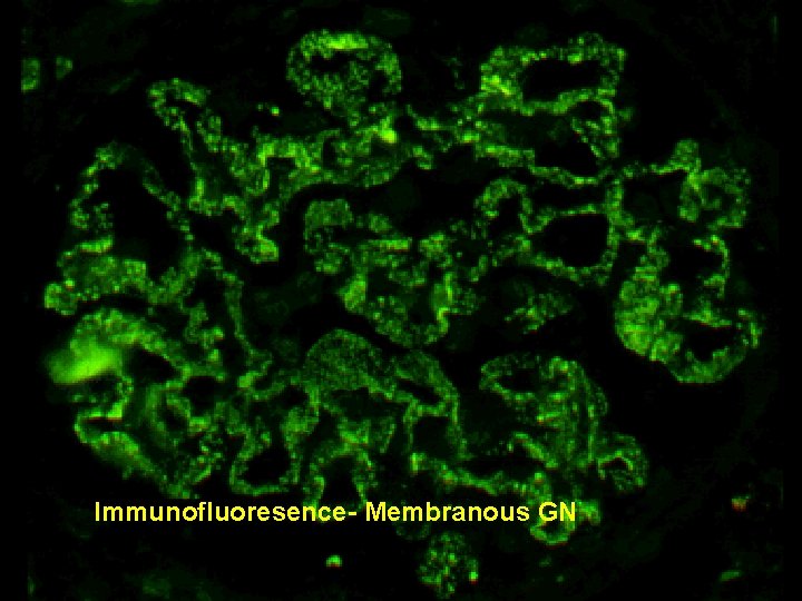 Immunofluoresence- Membranous GN 