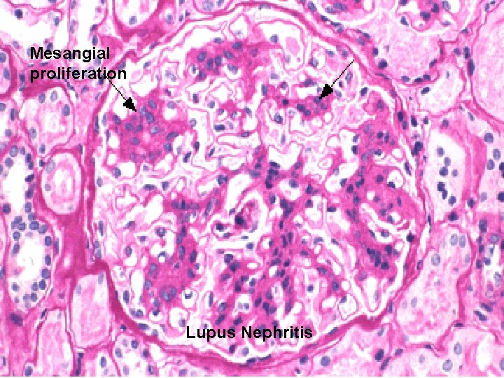 Mesangial proliferation Lupus Nephritis 