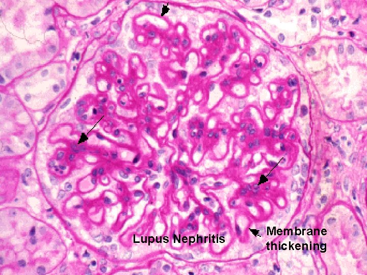 Lupus Nephritis Membrane thickening 