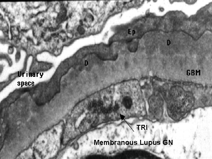 TRI Membranous Lupus GN 