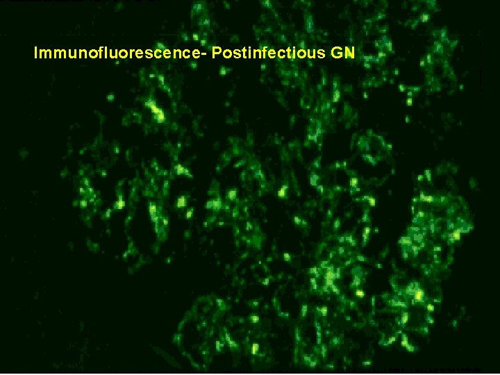 Immunofluorescence- Postinfectious GN 