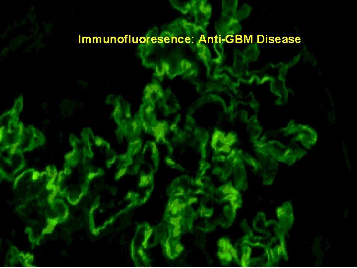 Immunofluoresence: Anti-GBM Disease 