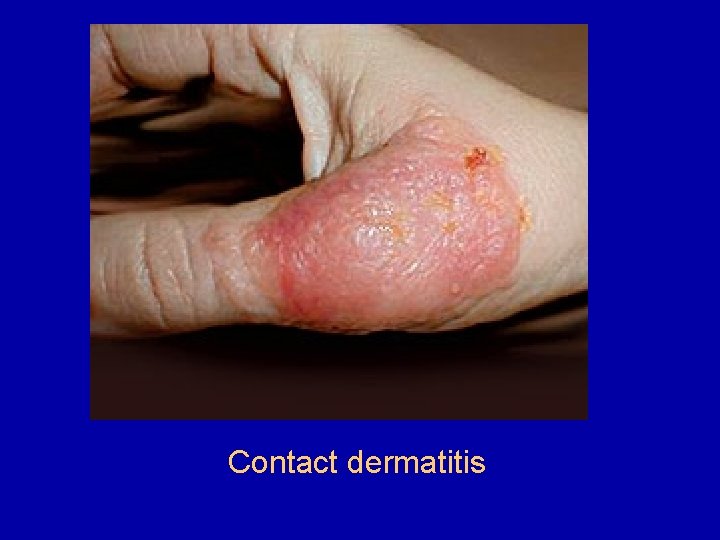 Contact dermatitis 