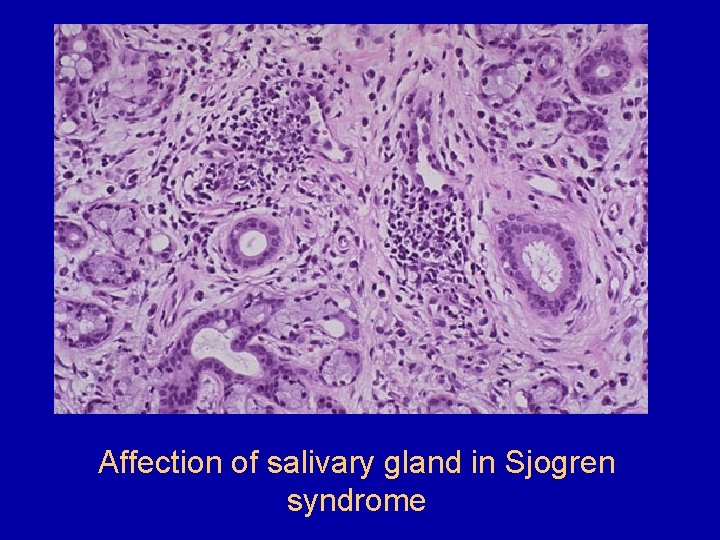 Affection of salivary gland in Sjogren syndrome 