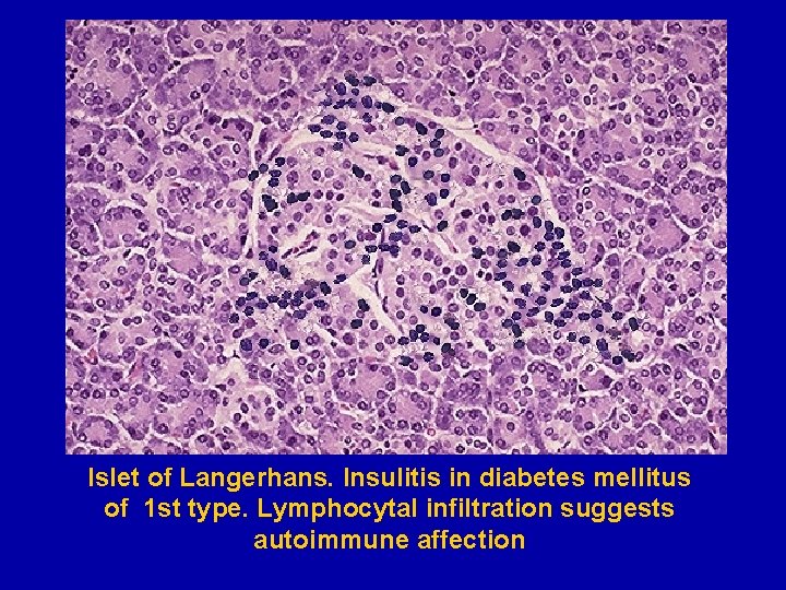 Islet of Langerhans. Insulitis in diabetes mellitus of 1 st type. Lymphocytal infiltration suggests