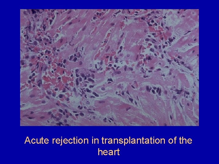 Acute rejection in transplantation of the heart Acute rejection in transplantation of the heart