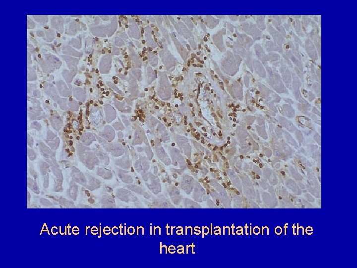 Acute rejection in transplantation of the heart 