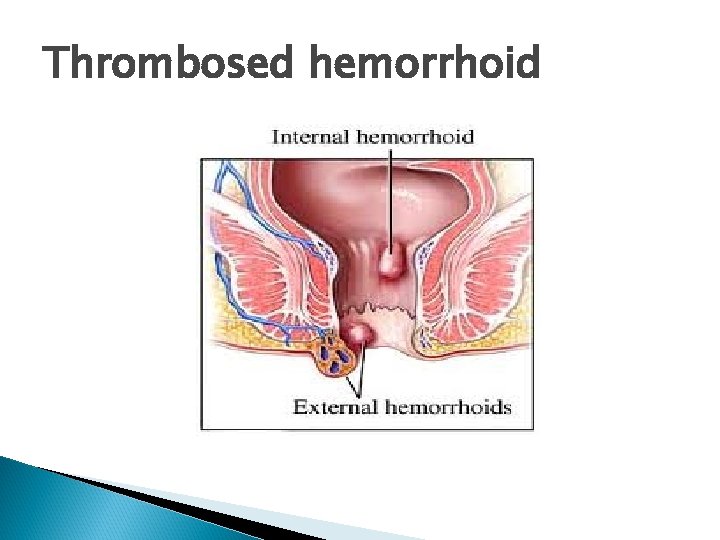 Thrombosed hemorrhoid 