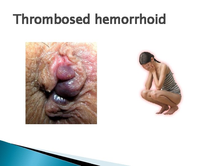 Thrombosed hemorrhoid 