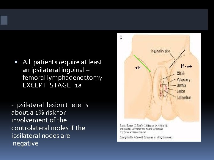  All patients require at least an ipsilateral inguinal – femoral lymphadenectomy EXCEPT STAGE
