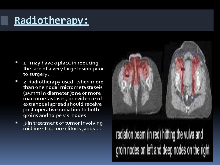 Radiotherapy: 1 - may have a place in reducing the size of a very