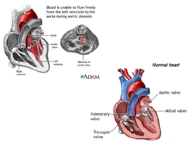 Normal heart 