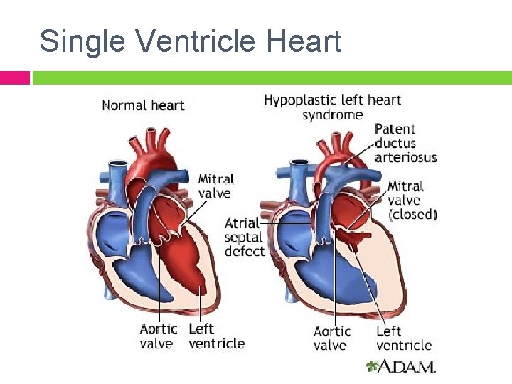 Single Ventricle Heart 