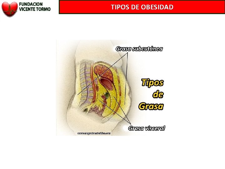 TIPOS DE OBESIDAD 