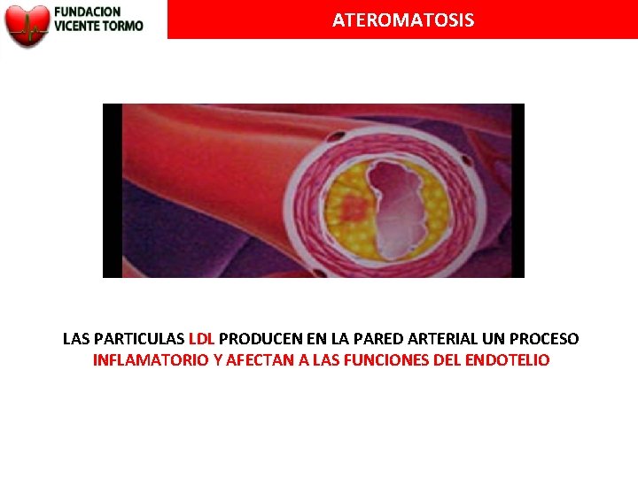 ATEROMATOSIS LAS PARTICULAS LDL PRODUCEN EN LA PARED ARTERIAL UN PROCESO INFLAMATORIO Y AFECTAN