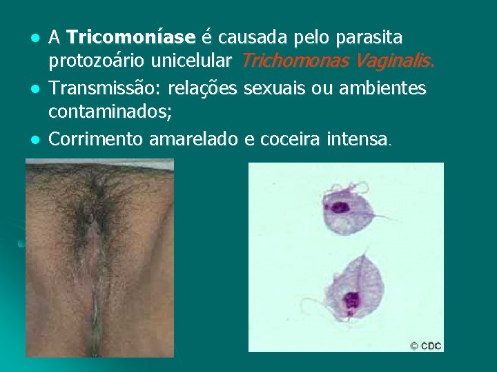 l l l A Tricomoníase é causada pelo parasita protozoário unicelular Trichomonas Vaginalis. Transmissão: